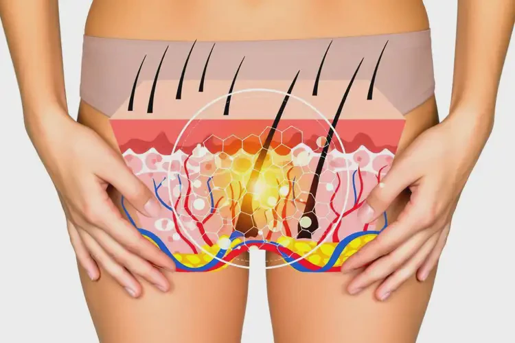 男人肛周容易長濕疹可以治好嗎(圖2)