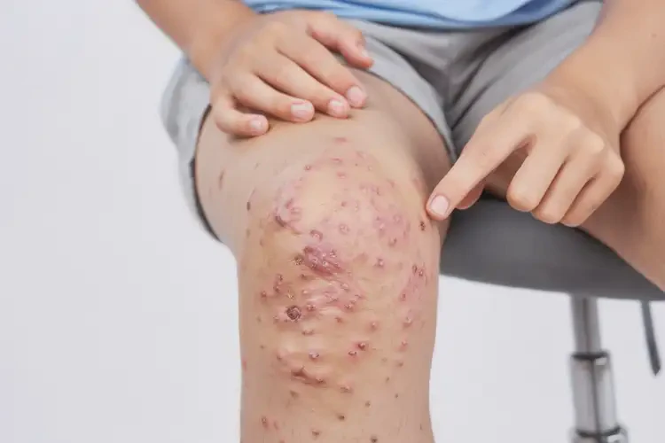 青少年大腿上容易起濕疹可以治好嗎(圖4)