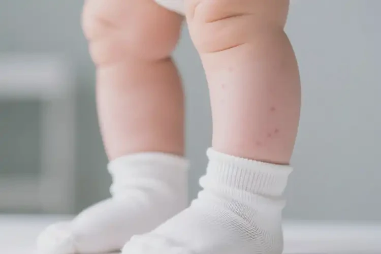 新生儿大腿容易长湿疹可以治好吗(图2)