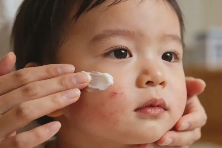 幼儿面部经常起湿疹可以治好吗(图1)