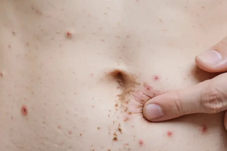 大學(xué)生肚子起濕疹可以治好嗎(圖4)