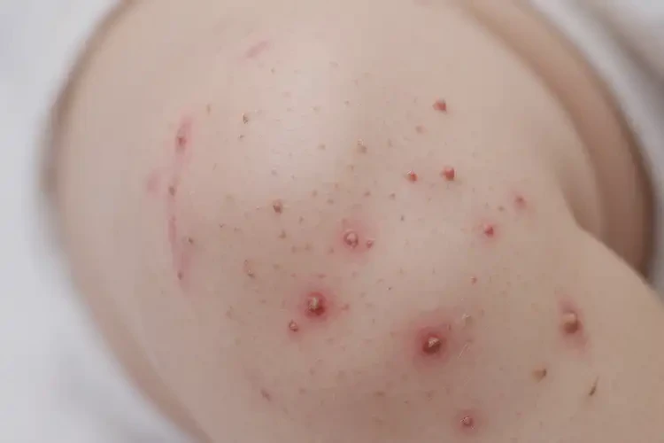 小兒大腿經(jīng)常長濕疹可以治好嗎(圖4)