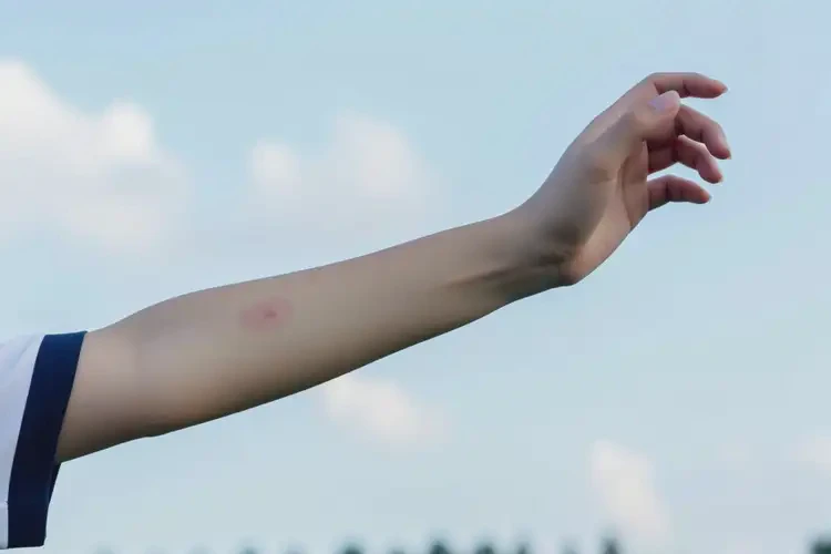 中学生手臂上偶尔长湿疹可以治好吗(图2)