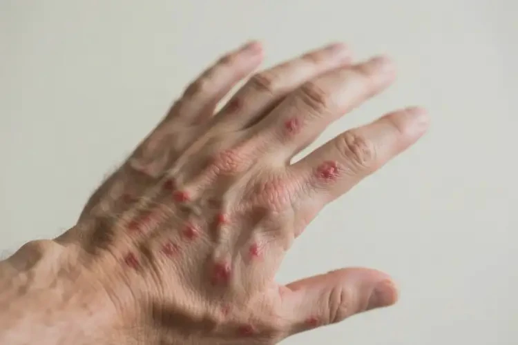 男人手上出現(xiàn)濕疹可以治好嗎(圖1)