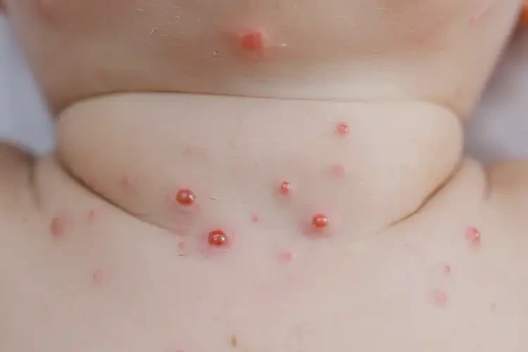 嬰兒脖子經(jīng)常起濕疹可以治好嗎(圖4)