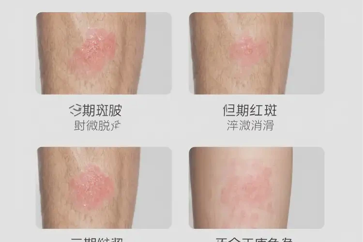 男生小腿上偶爾起濕疹可不可以徹底自愈(圖4)