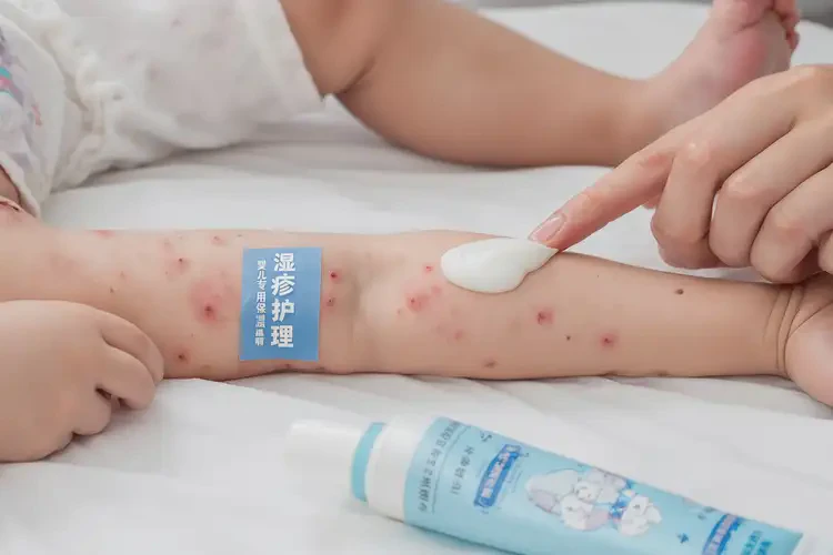 嬰兒手臂容易長濕疹能治好嗎(圖3)