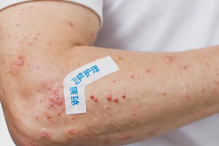 青年人手臂經(jīng)常起濕疹可以治好嗎(圖4)