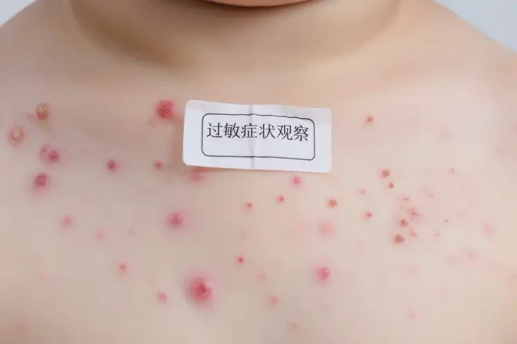 幼兒脖子上容易長(zhǎng)濕疹可以治好嗎(圖4)