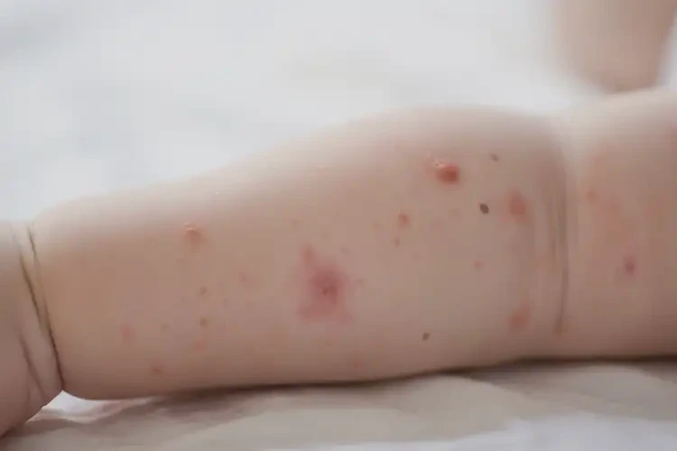 嬰兒手臂出現(xiàn)濕疹可以治好嗎(圖4)