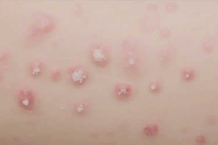 哺乳期妈妈大腿上长湿疹可不可以根治(图4)