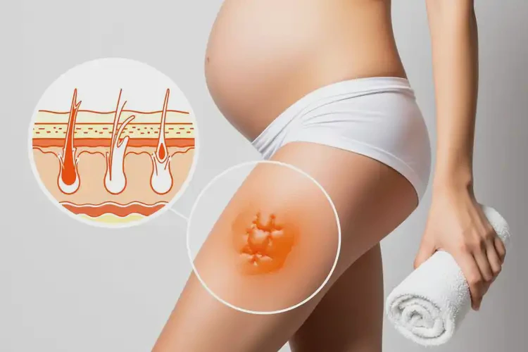 產(chǎn)婦大腿容易起濕疹可以治好嗎(圖2)