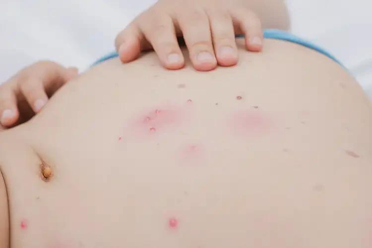 小兒肚子偶爾長濕疹可以治好嗎(圖4)