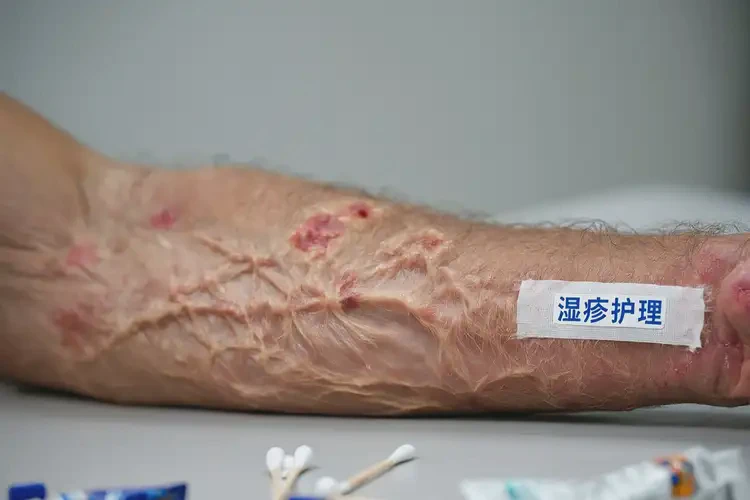 老年人全身有湿疹能靠自己自愈吗(图4)