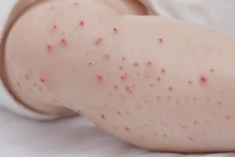 寶寶小腿上出現(xiàn)濕疹可以治好嗎(圖4)