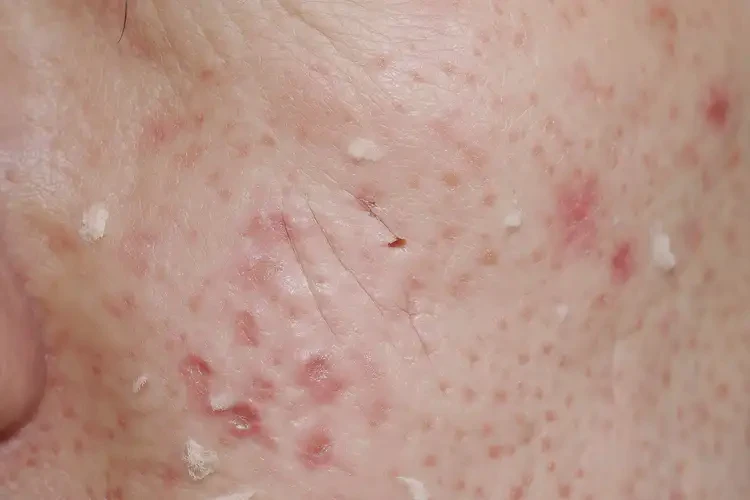 女生小腿偶尔长湿疹能够彻底治愈吗(图4)