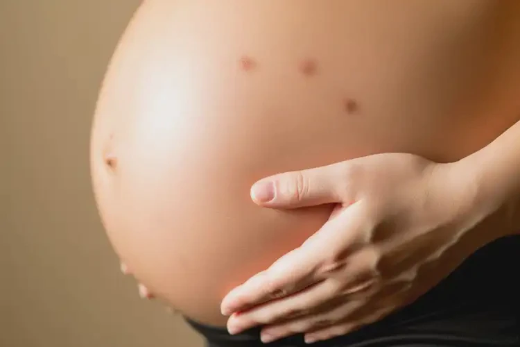 產(chǎn)婦肚子上容易長(zhǎng)濕疹可以治好嗎(圖3)