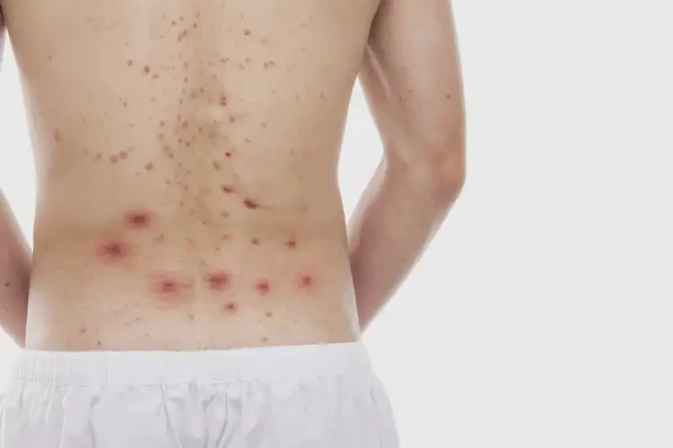 青年人屁股上容易長濕疹可以治好嗎(圖4)