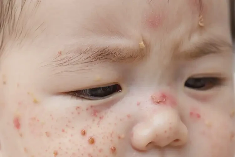 嬰兒全身經(jīng)常起濕疹可以治好嗎(圖4)