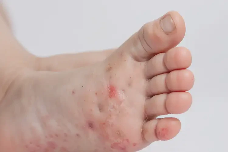 小學(xué)生腳上有濕疹可以治好嗎(圖4)