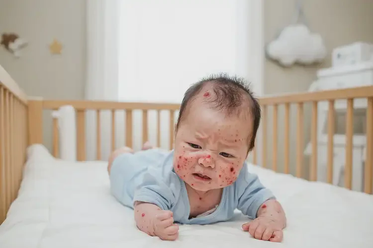 宝宝全身出现湿疹不管它会自己好吗(图2)