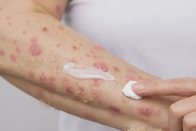 女性手臂偶爾長濕疹可以治好嗎(圖4)