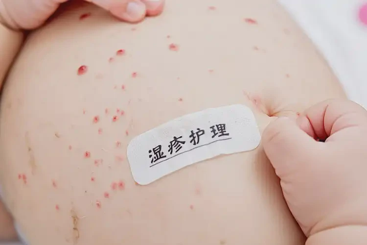 儿童肚子有湿疹可以治好吗(图4)