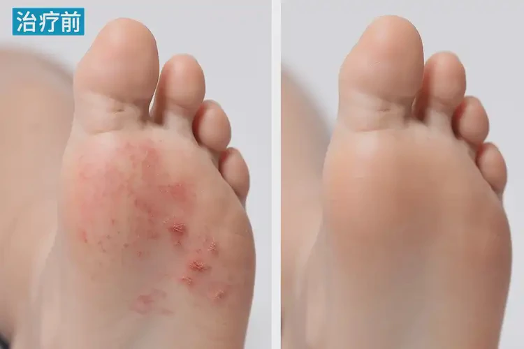 孩子脚上偶尔长湿疹可以治好吗(图4)