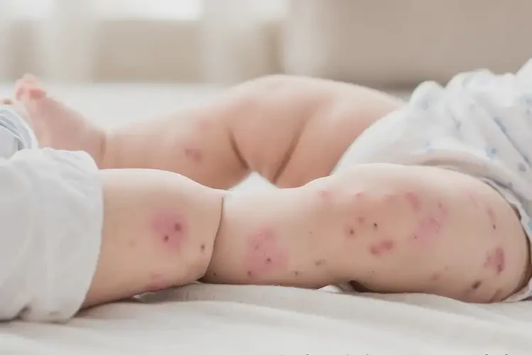 宝宝四肢经常长湿疹不管它会自己自愈吗(图4)