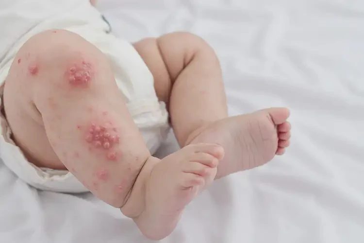 嬰兒小腿上有濕疹能治好嗎(圖1)