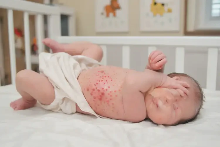 新生儿肚子上容易长湿疹可以治好吗(图4)