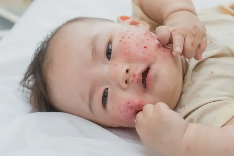 嬰幼兒身上偶爾起濕疹不管它會自己好嗎(圖4)