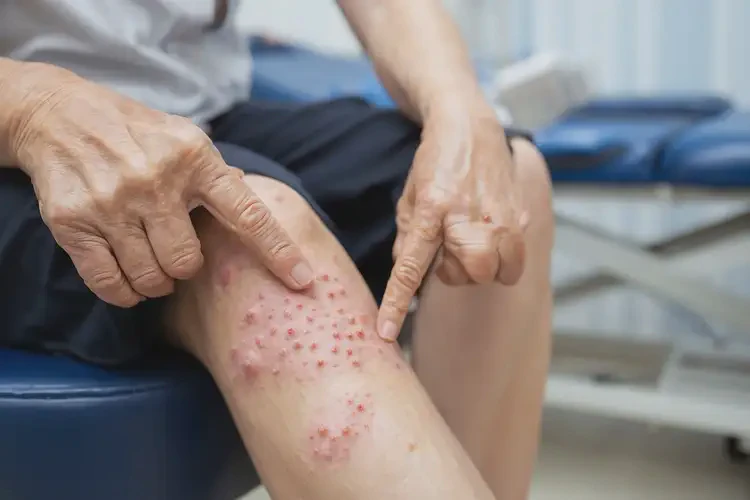 產(chǎn)婦小腿上偶爾起濕疹可以治好嗎(圖4)