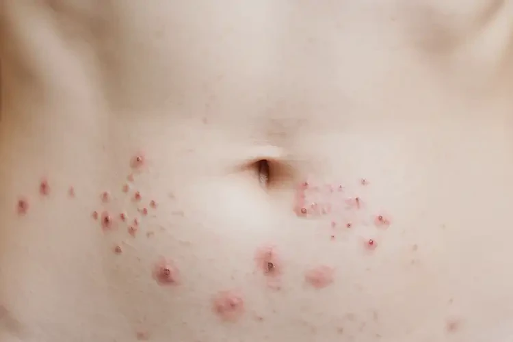 女生肚子上經(jīng)常起濕疹可以治好嗎(圖4)