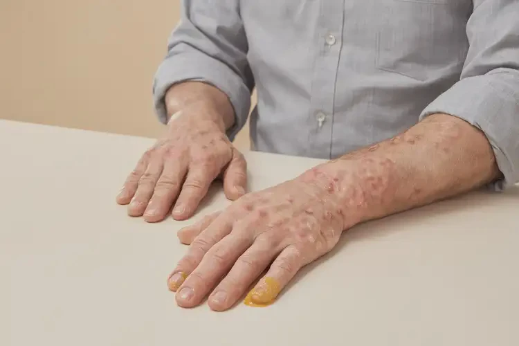 男性手上經(jīng)常起濕疹可以治好嗎(圖3)