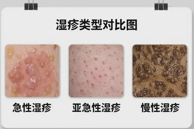 大學(xué)生身上有濕疹可以治好嗎(圖3)