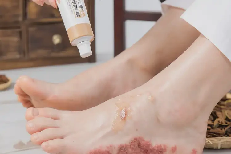 女性腳上容易長(zhǎng)濕疹可以治好嗎(圖2)