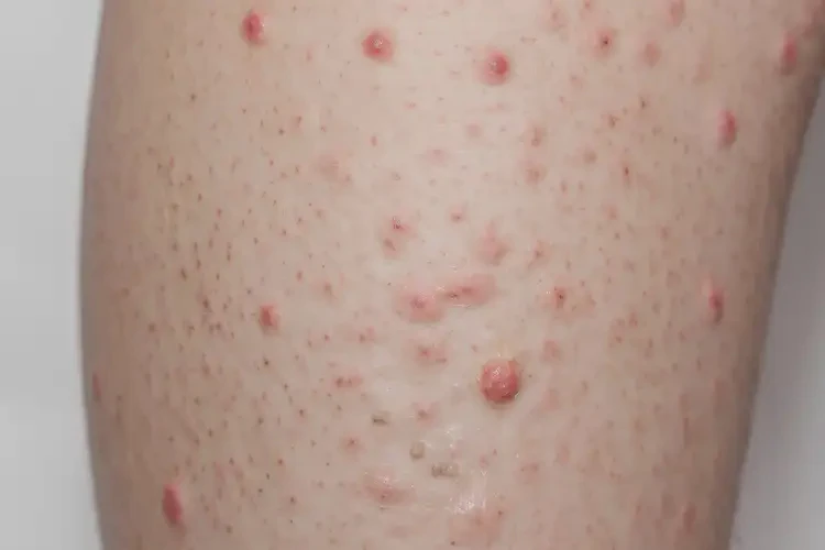 中學(xué)生大腿上出現(xiàn)濕疹可以治好嗎(圖4)