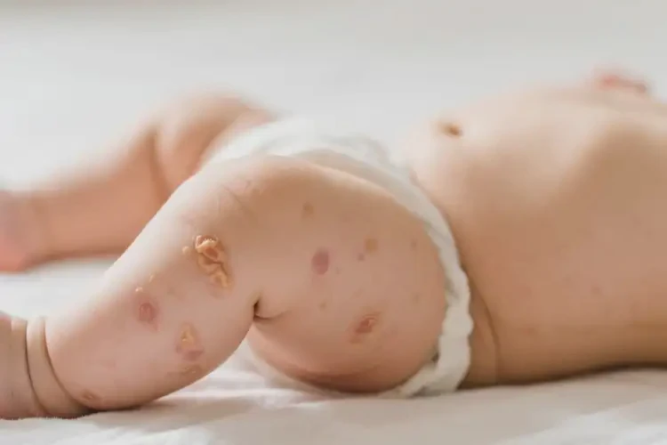 嬰兒大腿上偶爾長濕疹能治好嗎(圖1)