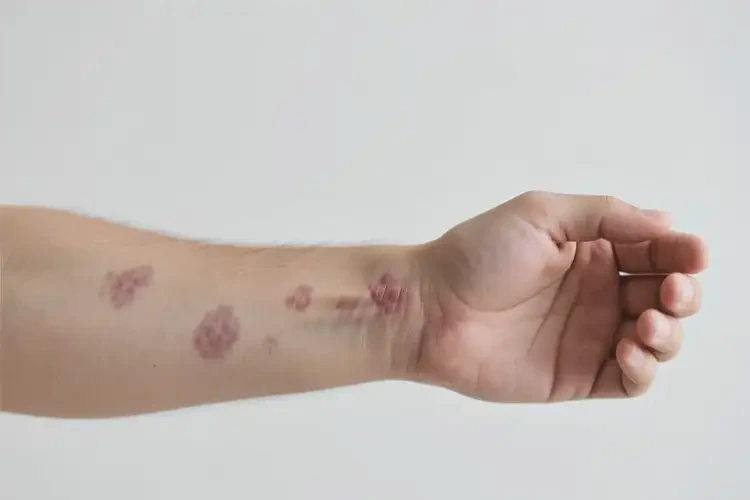 男生手臂出現(xiàn)濕疹可以治好嗎(圖1)