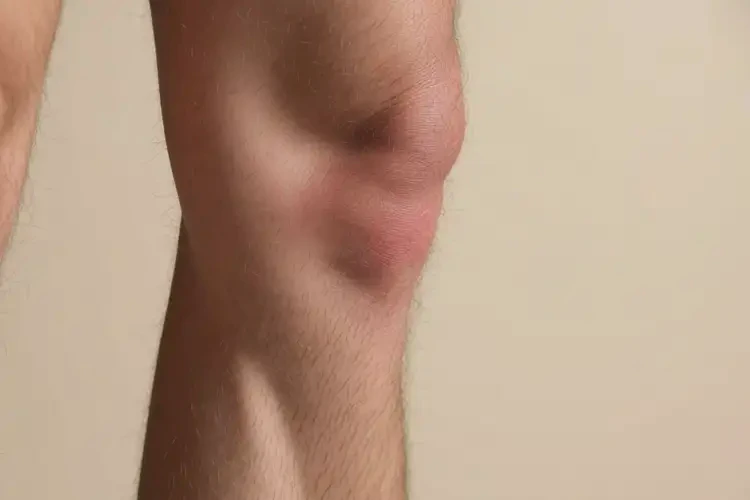 男性小腿上偶爾長濕疹可以治好嗎(圖4)