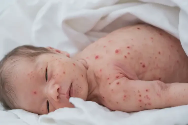 新生儿身上经常长湿疹可以治好吗(图4)