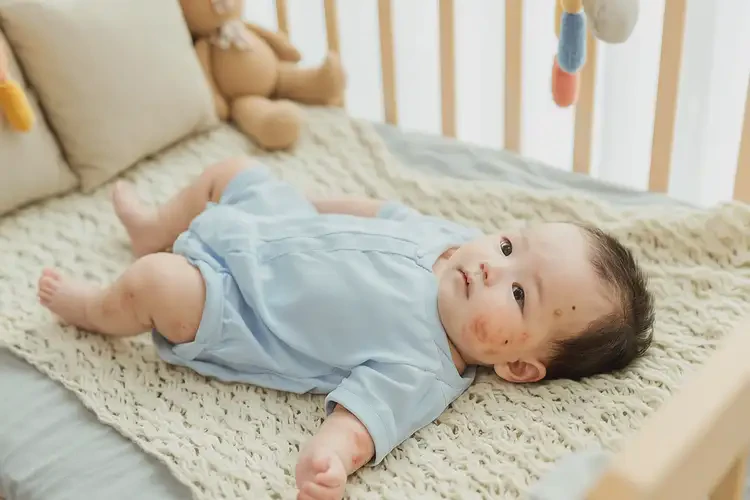 嬰兒手臂出現(xiàn)濕疹可以治好嗎(圖2)