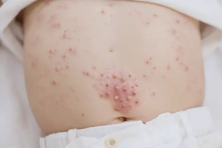 嬰幼兒肚子上長濕疹可以治好嗎(圖4)