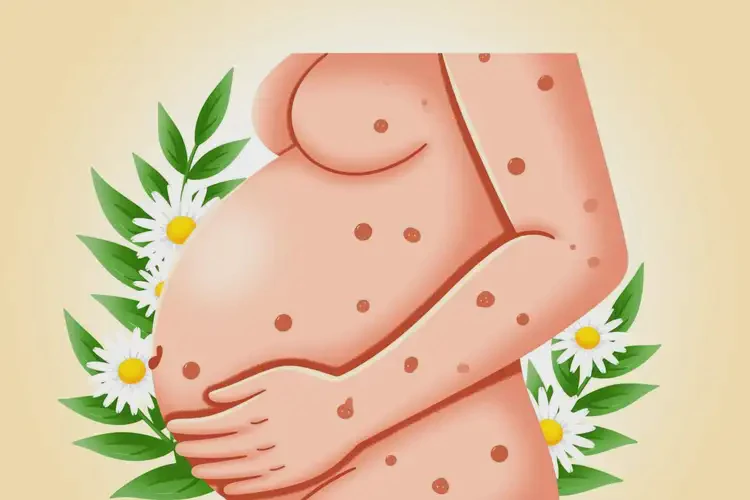 產(chǎn)婦手臂上經(jīng)常起濕疹可以治好嗎(圖4)