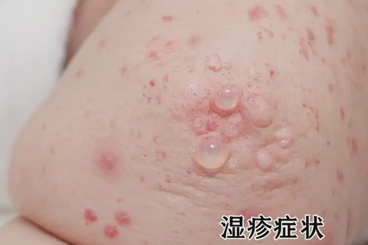嬰兒小腿上長(zhǎng)濕疹可以治好嗎(圖4)