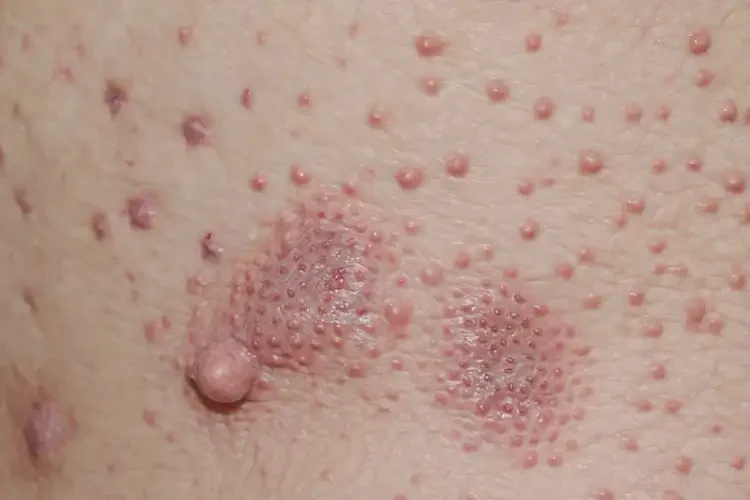 男人肛周長(zhǎng)濕疹可不可以徹底自愈(圖4)