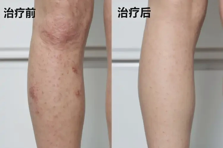 大學(xué)生小腿容易起濕疹可以治好嗎(圖4)