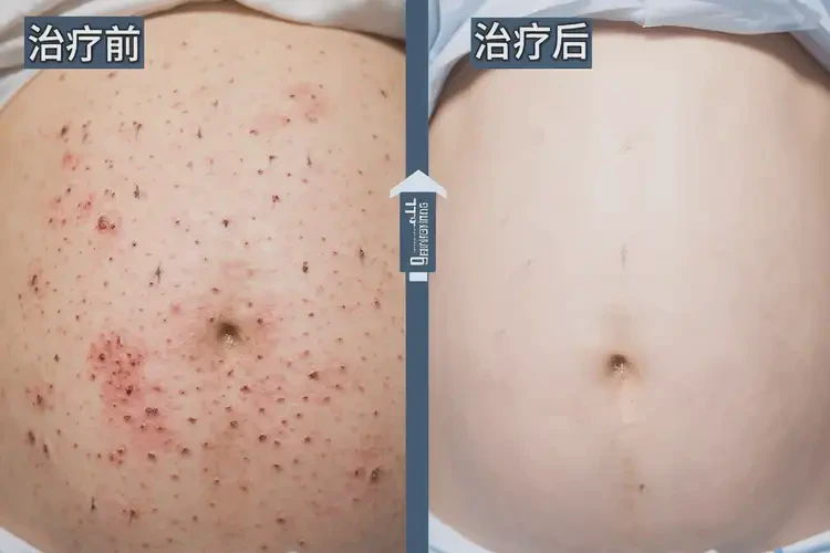 產(chǎn)婦全身有濕疹可以治好嗎(圖4)