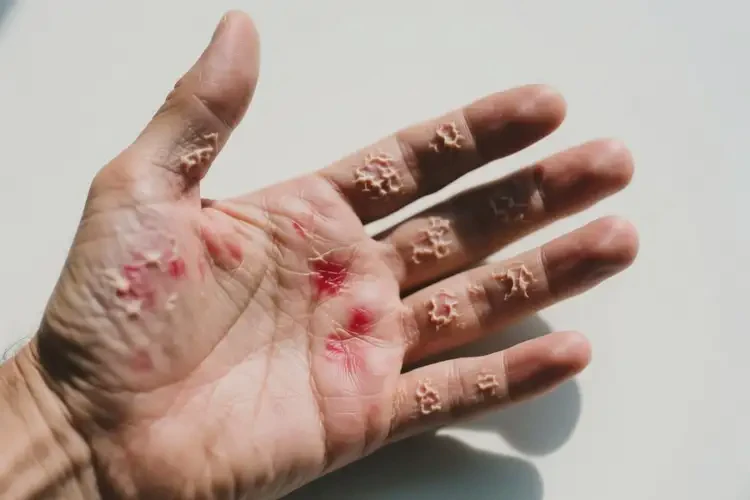 男人手上出現(xiàn)濕疹可以治好嗎(圖2)